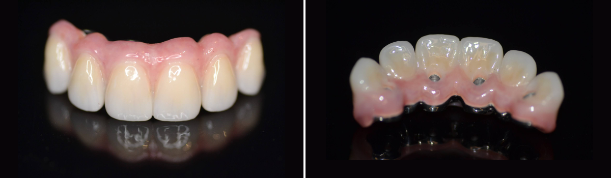 Barre hybride CAD-CAM : optimisez vos prothèses implantaires